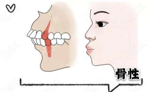 孩子骨性龅牙做正畸佳时间