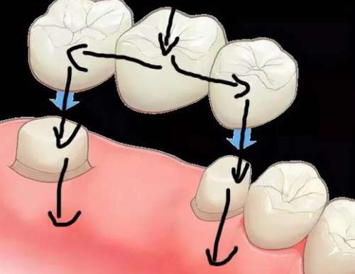 后面没有牙齿了还能镶牙吗？镶牙的常用方法