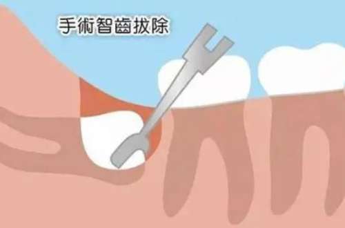 拔智齿后能否报学校医保？了解一下相关政策！